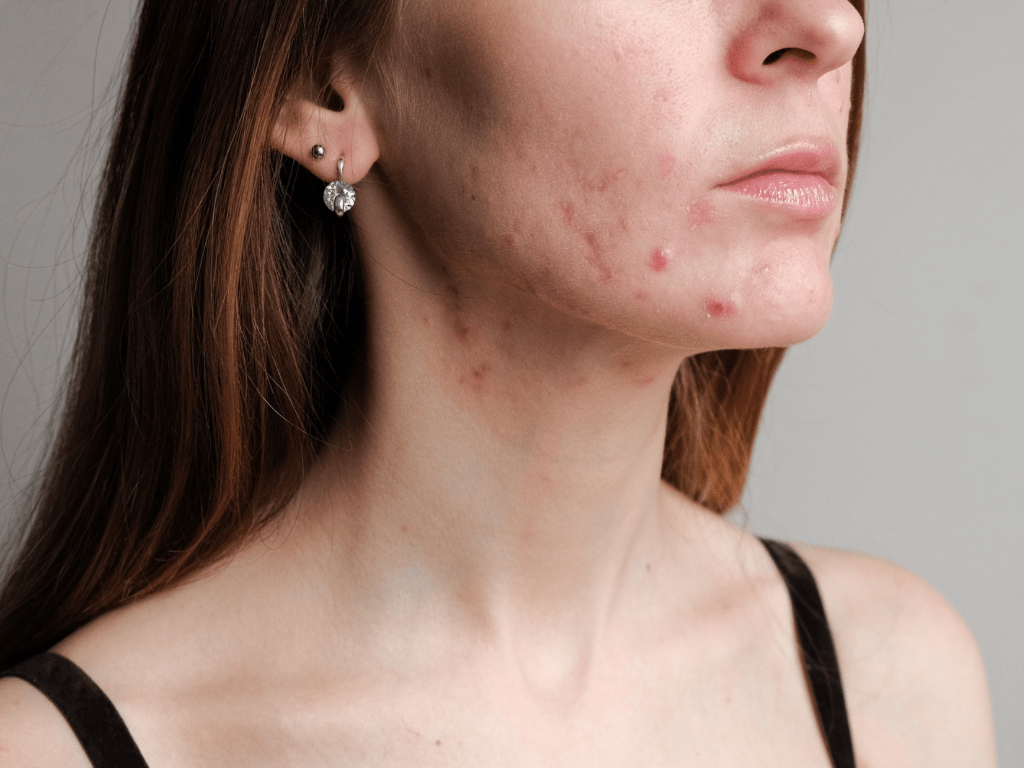 Microbiota-piel-acne