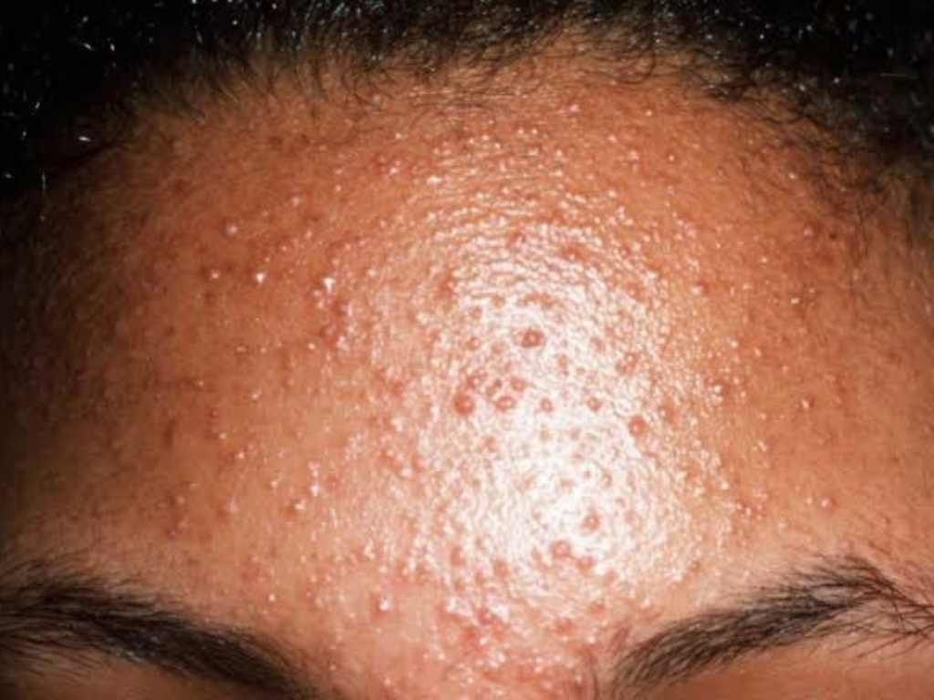 Malassezia_foliculitis_acne_fungico