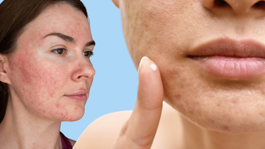 Rosacea y acne