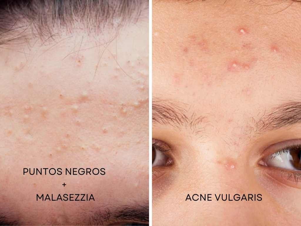 Malasezzia_acne_fungico_acne_vulgaris