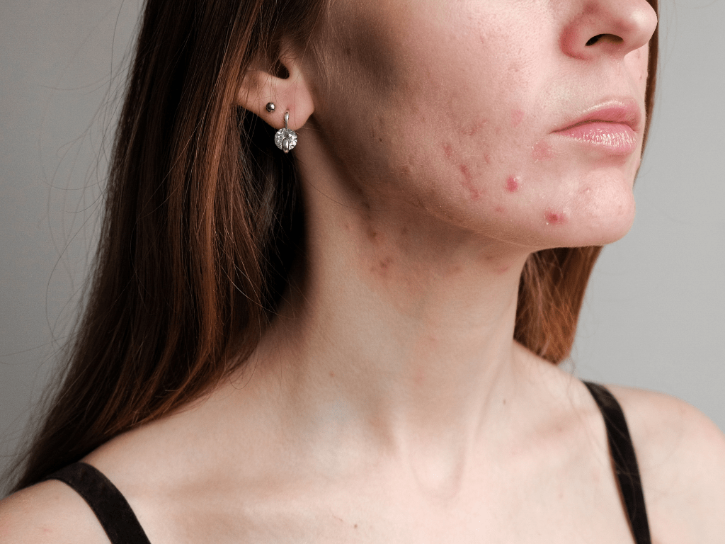 Acne Hormonal Inflamatorio