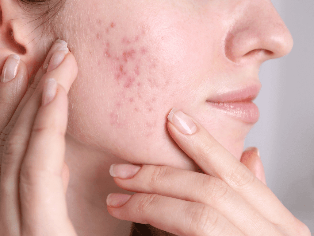 Todo sobre el Acné Hormonal y Skincare No Comedogénico