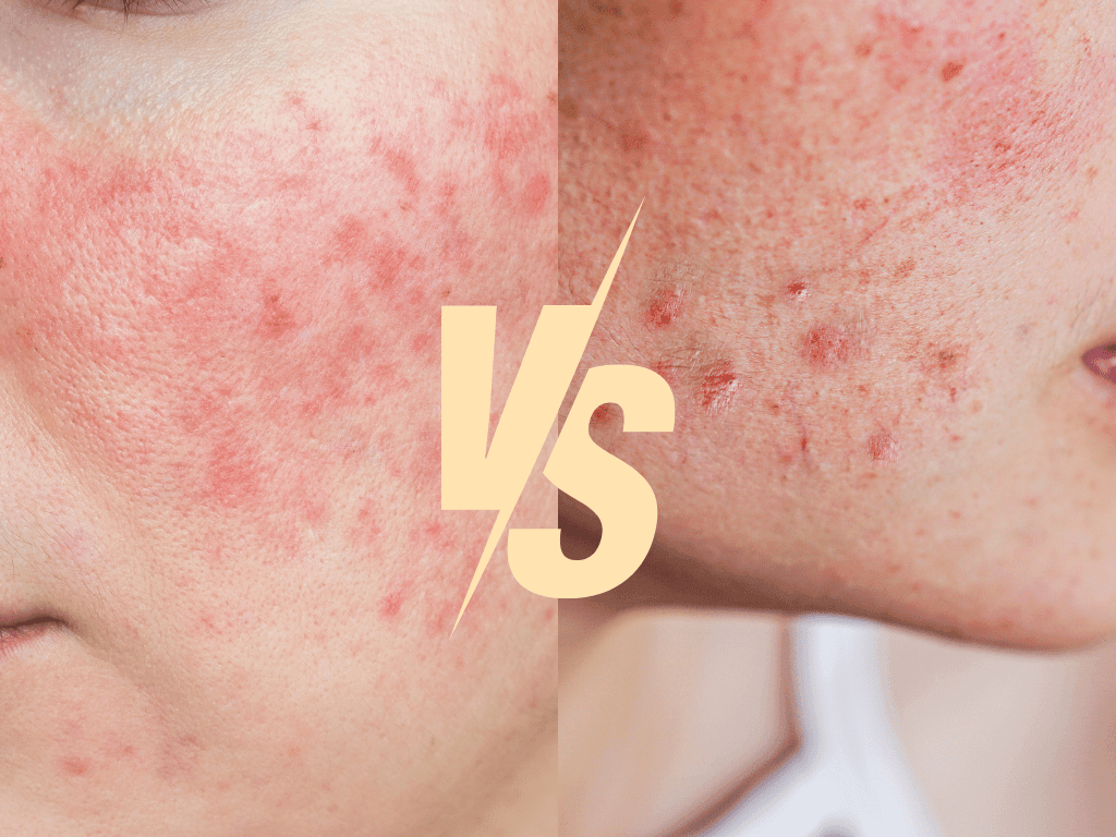 Acné VS Rosácea, ¿Sabes lo que Sufres?