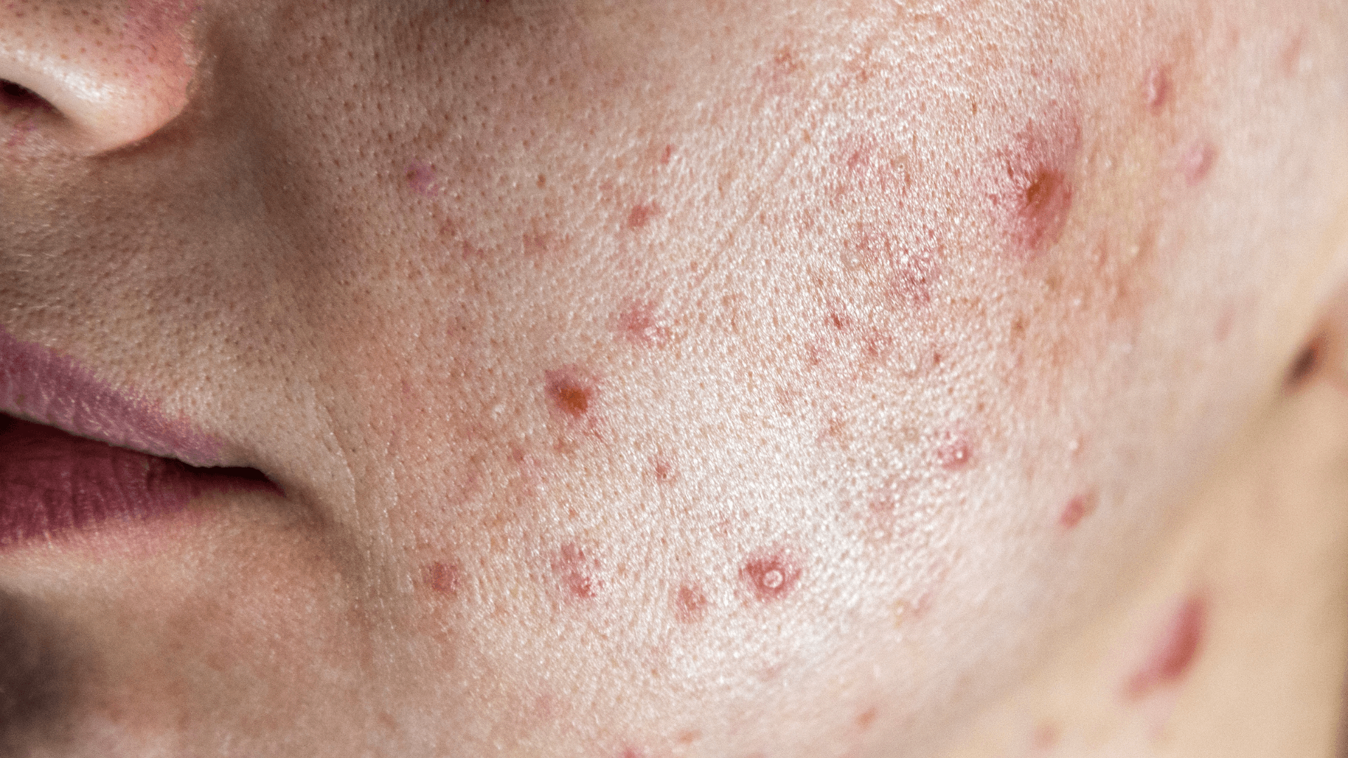 Acné: Por qué se produce